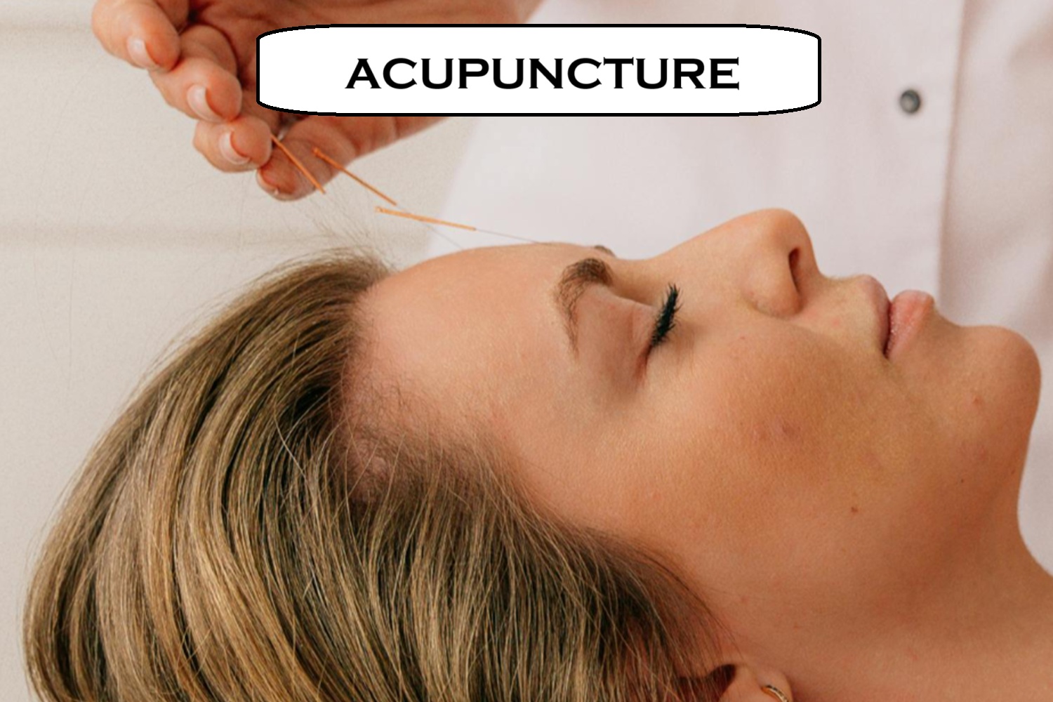 acupuncture