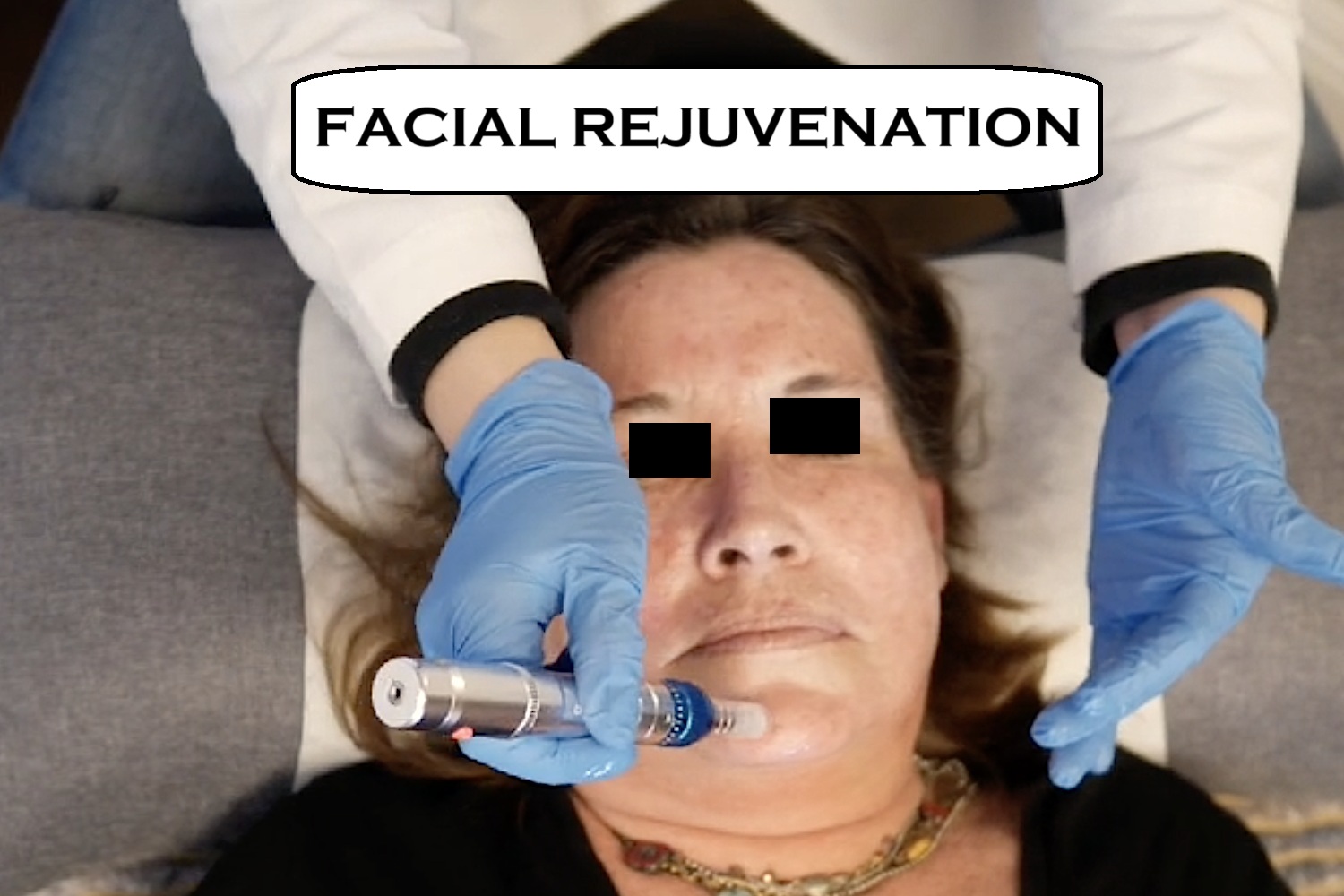 facial rejuvenation