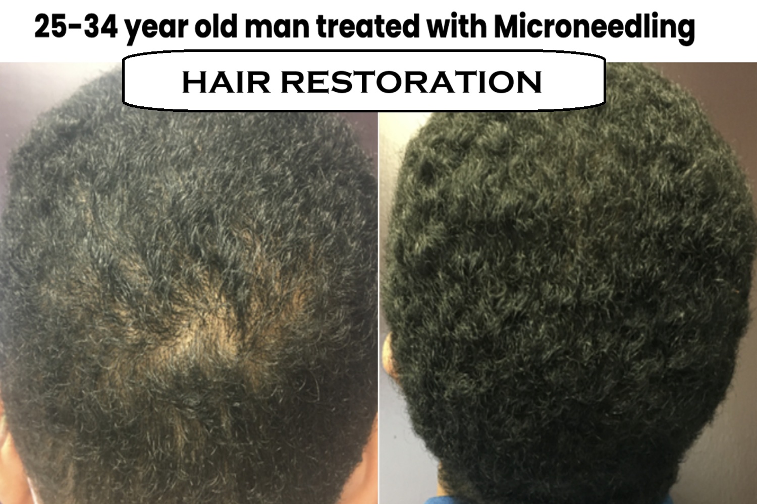 hair restoration